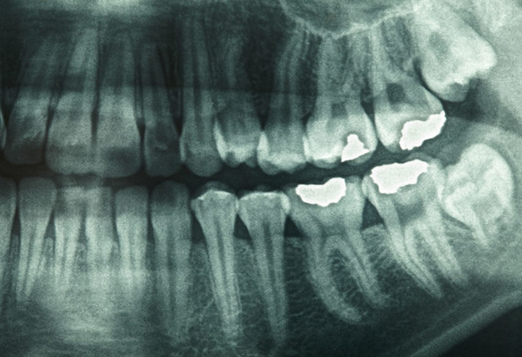 dental-xray-1_522x357_bbc